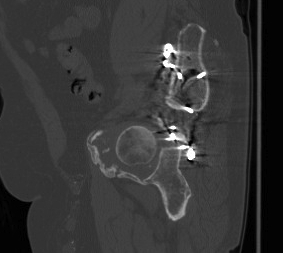 Acetabular Fracture Failed ORIF CT 2